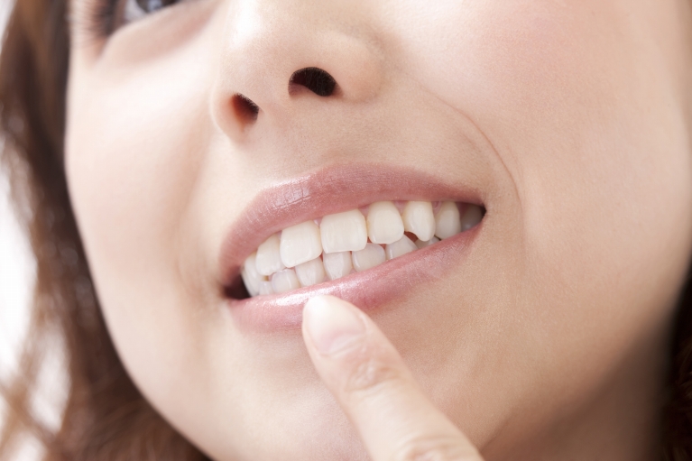 歯周ポケットの細菌が歯肉に炎症を起こし、歯が抜けることも…